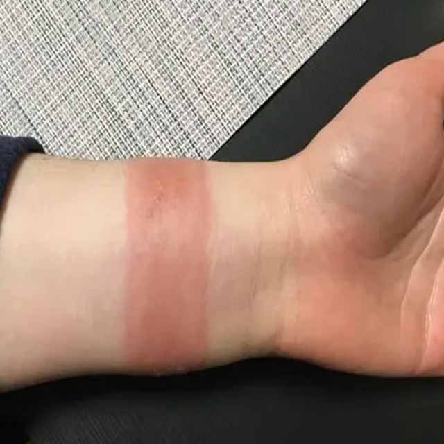 Đeo dây đồng hồ da bị dị ứng
