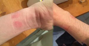 Đeo dây đồng hồ cao su bị ngứa có thể do dị ứng hoặc dây kém chất lượng
